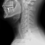 x-ray bone jaw neck