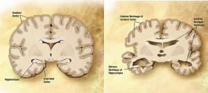 Alzheimers Drugs Hippocampus Neurogenesis